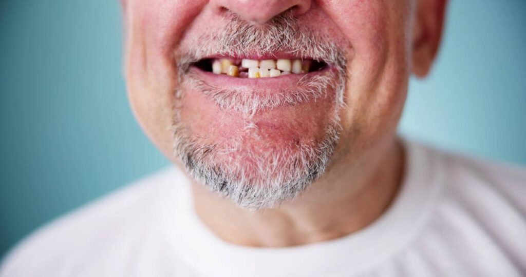 Featured image for Can You Get Dental Implants If You Have Periodontal